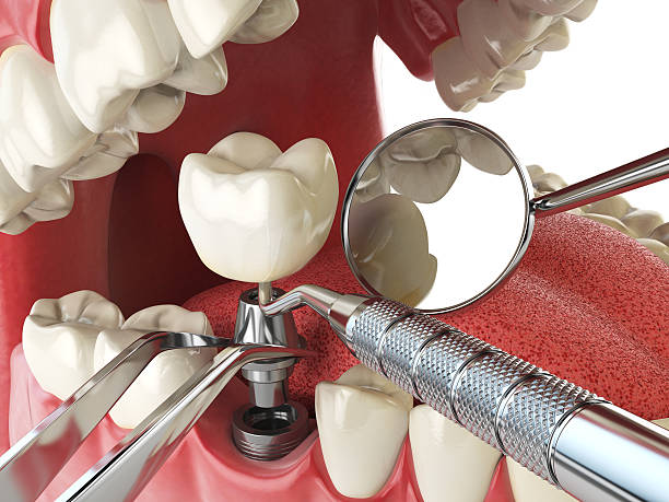 Best Tooth Infection Emergency Dentist  in Kinder, LA